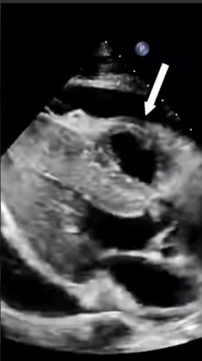 RV diastolic collapse in cardiac tamponade