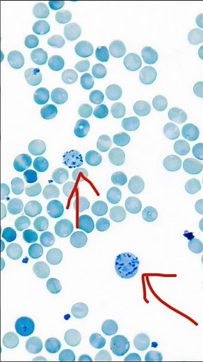 Haemolytic Anemia Reticulocytosis . Why ?? #pathology #pathologyviva #hematology