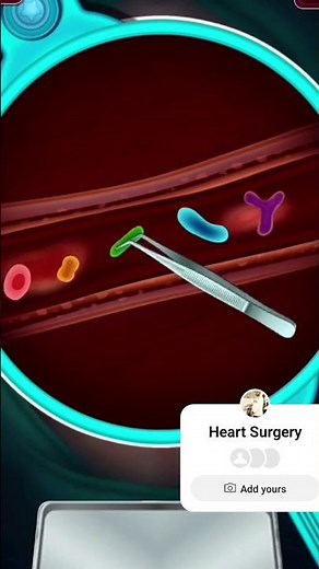 How Does Heart Bypass Surgery Work? Coronary Artery Bypass Graft Procedure Animation. Today proceger