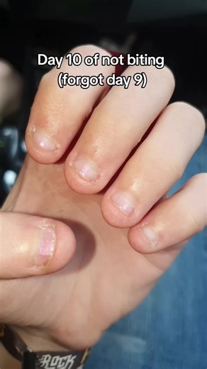 #nailbiting #teamwork #bitingnails #fyp #day10