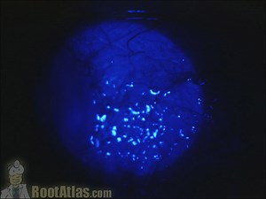 Glaucoma Drop Side Effects (Video) - TimRoot.com