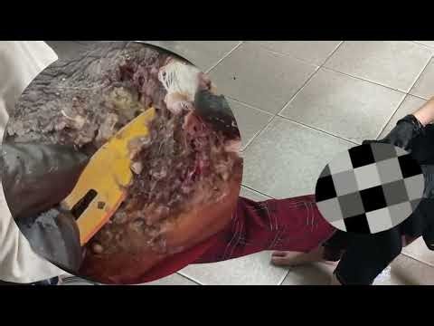 🤯 Jigger Infestation Horror – Skin Full of Parasites #NR179