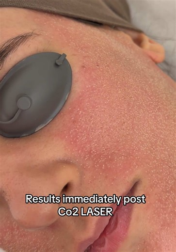 Treating acne scars with co2 laser #co2laser #co2 #acnetreatment #acnescar