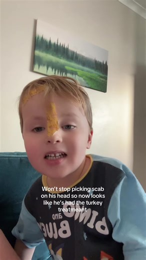 Dancer's Scab Picking Habit Leaves Unique Mark