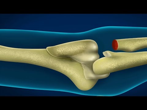 Radial Implant Surgery Step-by-Step