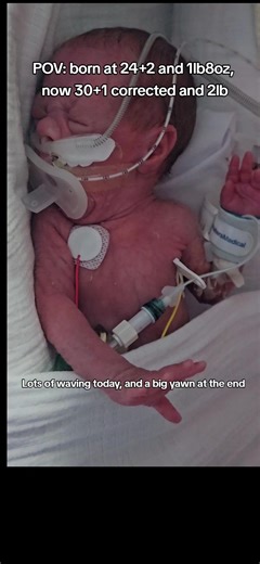 Waving and a big yawn 🥱 putting hands to the face and mouth are very good development signs, especially for such a premature baby whose brain isn't yet developed. Control of body and limbs is limited until they are bigger and older. #NICU #prematurebaby #Preterm #IVF #baby