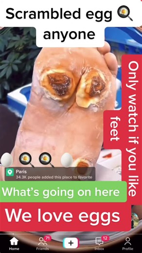 #fypシ #reaction #warner #warn #pimplesandblackheads #pimplesandblackheads #dermdoctor #dre #blackhe #cyst #cystpopping #cystexplosion #cystpopping #cystpop