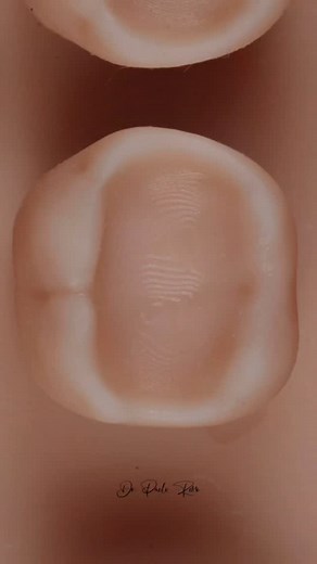 1.8K views · 223 reactions | Class I Copmposite  #dentalcourses #DentalEducation #dentistry | Dental Art | Facebook