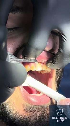 Satisfying Dental Filling Procedure ASMR (Part 1) #asmr #dentalartistry #dentalprocedure