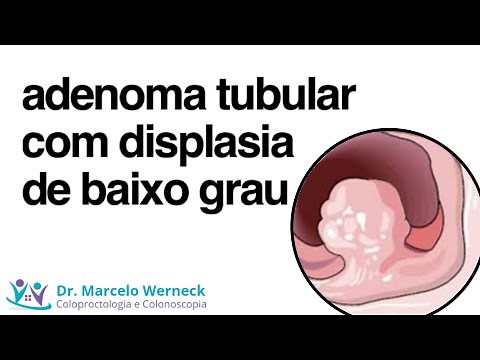 Tubular adenoma with low-grade dysplasia. What is it?