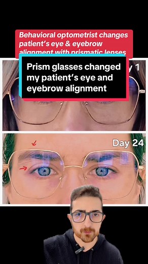 Transforming Vision with Prism Lenses