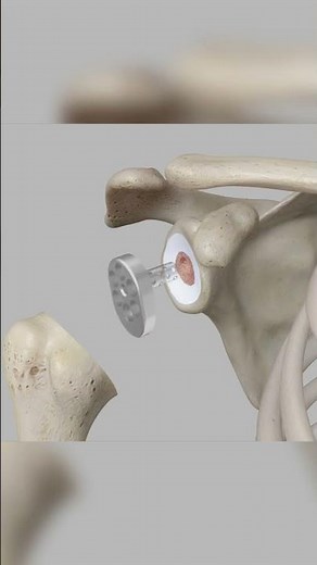 Types of Shoulder Replacement with Dr. Christopher Stark