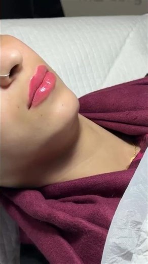 Fuller Yet Natural 👄 Precision Lip Fillers by Dr. Salman