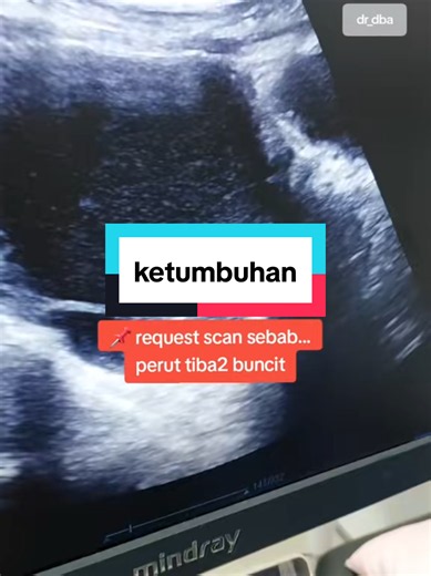 jika perut rasa bloated... perut rasa buncit sedikit... rasa ada benjolan bahagian bawah perut... walaupon period teratur... better check di klinik ya... harap2 tiada ketumbuhan cyst atau fibroid 😊 🤲🏻 #cyst #ovariancancer #tumor #ttcjourney #marissawangsamaju
