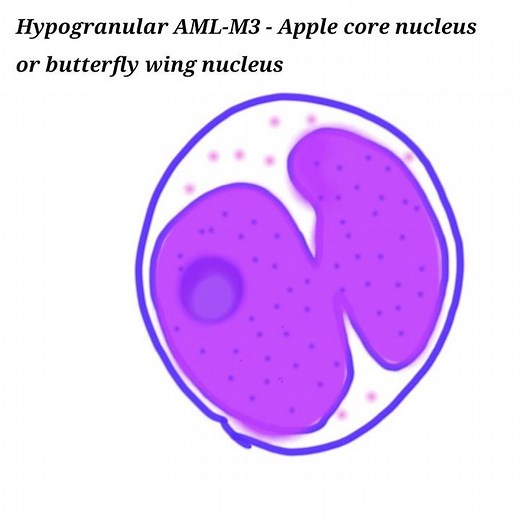 Difference between microgranular and hypergranular variant of AML-M3( APML) | Pathology for all