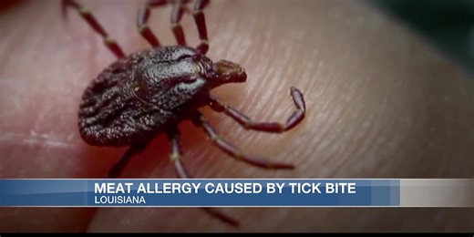 Thousands experiencing red meat allergy from ticks