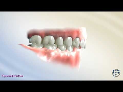 Reverse Curve (Lower Arch)