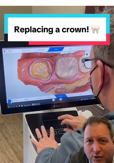 Dental Crown Replacement Process Explained