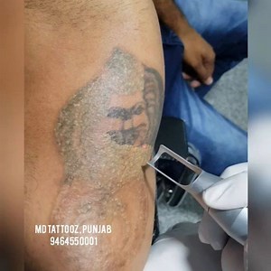 plz follow us @mdtattooz .Remove your tattoo now with the safest method. . Call for appointment 9464550001 . Please share with your friends to support our work. . . #tattooformen #tattooforgirls #phagwaratattoo #punjabtattoo #mdtattoos #tattoos #ink #tatto #smalltattooremoval #howtoremovetattoo #lasertattoo #singga #jazzyb #sidhumoosewala #club #jattblike #smalltattoo #illustration #punjabtattoo #art #blacktattoo #tattooforboys #tattooforgirls #tattooremovalhoshiarpur #tattooremovalludhiana #tat