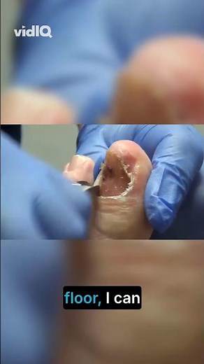 Injury Stories How Accidents Happen! Senior Patient Explains How Her Leg Injury Happened