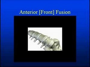 Back [Lumbar] Fusion Surgery for Pain, Sciatica & Stenosis