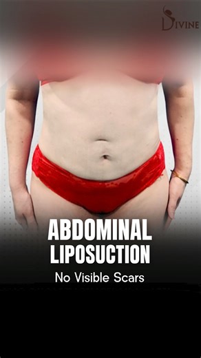 4 Weeks After Abdominal Liposuction | Early Transformation & Visible Contour Change