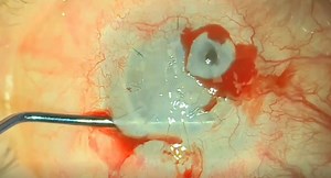 Mini DSEK for Corneal Perforations - Eyetube