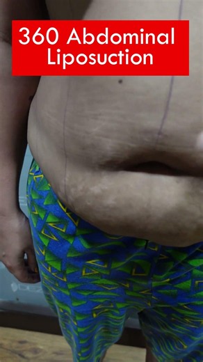 360 Abdominal Liposuction Marking