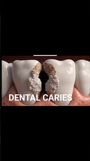 HOW Caries form?3D
