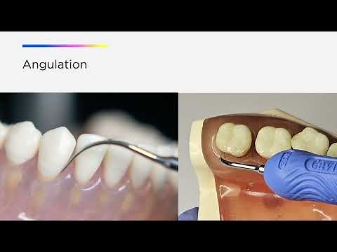Optimize your Cavitron® Ultrasonic Technology; The Three A’s of Ultrasonic Instrumentation