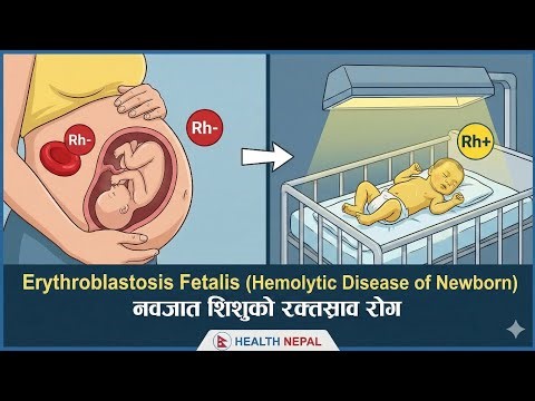 Rh Incompatibility & Erythroblastosis Fetalis - Explained in Nepali (please watch in 2x speed)