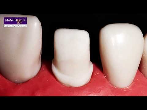 Dentine Bonded Crown Preparation