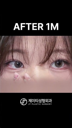 자연유착과 눈매교정으로 또렷한 눈매!