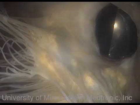 Mechanical Aortic Valve