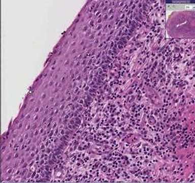 Histopathology Cervix- - Squamous cell carcinoma