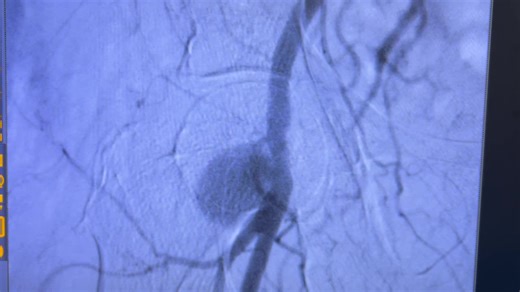 🚨 Complication Management in Interventional CardiologyDuring a recent angioplasty, we encountered a post-procedure pseudoaneurysm in the common femoral artery.While pseudoaneurysms are more often… | DR. SUSHANT PATIL