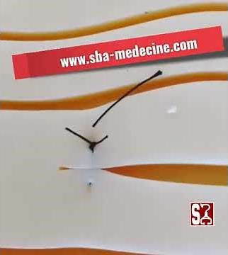 la Suture pour les nuls - techniques : Point Matelassier simple vertical (Point de Blair-Donati)