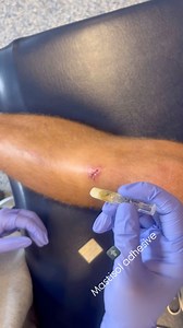 Taylor Ana Kaylee Sports Medicine on Instagram: "Steri-strip application!🤕 This should be applied by a medical professional to wounds smaller than a half inch and wounds that do not require stitches. Wounds that require stitches/glue/hospital visit: -lacerations on the face -uncontrollable bleeding -wounds larger than a 1/2 inch -wounds that are gapping & deep -life & limb threatening locations Etc. WHEN IN DOUBT SEND TO THE HOSPITAL 😊 Steri-strip steps: 1. Clean wound/skin around wound 2. App