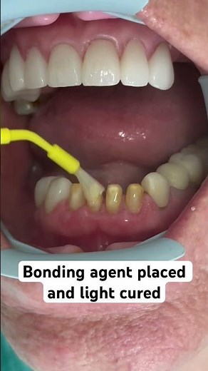 Step by step , natural looking lower porcelain veneers ❤️
