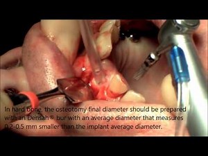 Implant placement using Densah® burs by Versah®