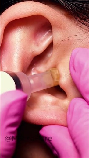Clinical Ear Comedone Removal | Vacuum Dermatology ASMR #dermatology #asmr