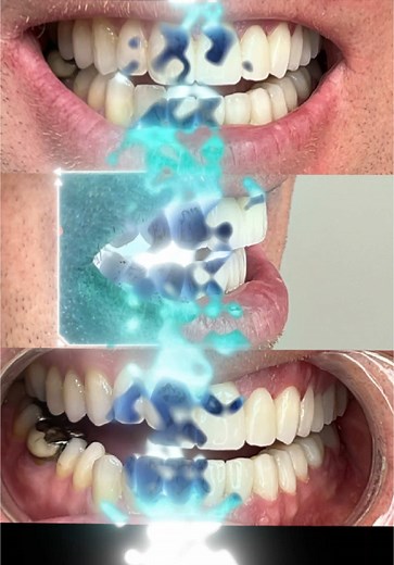 New smile transformation with zirconia crown 🦷✨