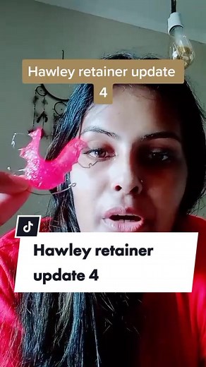 hey guys update 4 of my Hawley retainer. I'm almost done with the process. Painful but worth it.#hawleyorthodontics #hawleyretainer #hawleyretainers #retainer #teethproblems #overbite #overbitecorrection #orthodontics
