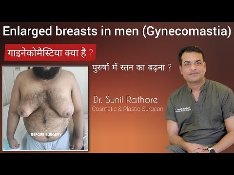 Gynecomastia - Enlarged Male Breast Tissue | पुरुष स्तन (Male Breast) : गाइनेकोमैस्टिया क्या है ?