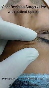 Face Scar Revision Treatment Happy Patient, India, Delhi