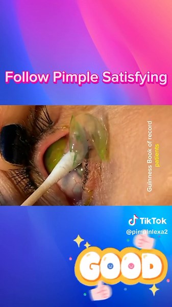 Big Pimple blackheads removal #viral #pimple #satisfying #popping #acne #acnetreatment #relax #extractions #nails #eyes