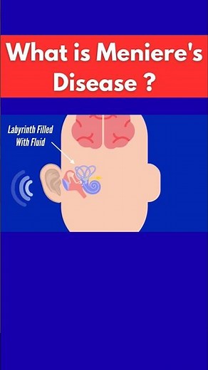 Meniere’s Disease Explained: Causes, Symptoms, Tinnitus vs Vertigo, and Treatment
