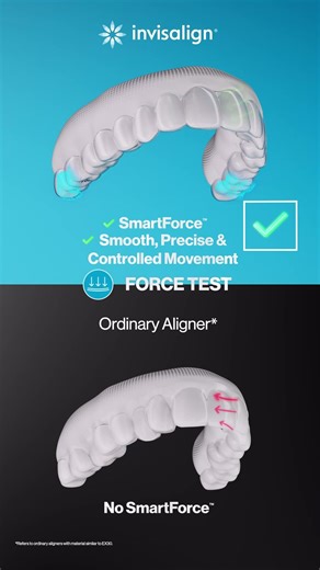 Invisalign | 5 Test Check