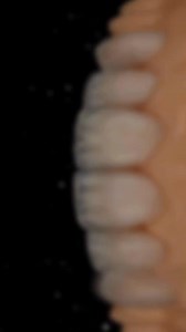 Case veneers lithium disilicate ingots( ceramotion Lisi) layered by ceramic (Ceramotion Zr) https://www.instagram.com Digital Dental Academy #Ceramotion #Zircaglaw #DentalCeramics #ceramotionlisi #AestheticDentistry #dental #dentistry #dentist #dentalimplants #dentallab #dentallaboratory #digitaldentalacademy #ceramotion #dentaurumgermany #ceramotiononetouch #mohamedhasanhelal #mhgroupcoegyptdental | Mohamed Hasan