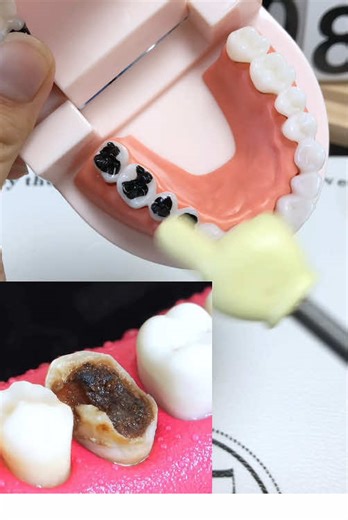 Let me save your Bad teeth! #badteeth #badbreath #hydroxyapatite #yellowteeth #teethhealth